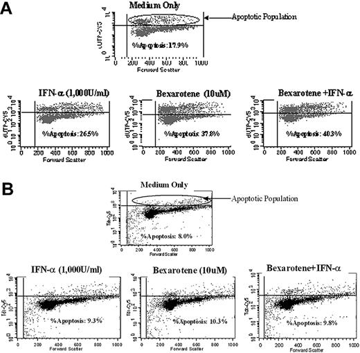 Figure 1. Bexarotene-induced apoptosis of HTLV-1–infected cells before therapy and after relapse of disease. Patient PBMCs were cultured in vitro with medium only, bexarotene (10 μM), IFN-α2b (1000 U/mL), or a combination of bexarotene (10 μM) and IFN-α2b (1000 U/mL) and subjected to flow cytometry. (A) Cells isolated at day 0, before therapy. The percentage of apoptotic cells more than doubled with bexarotene, increasing from 17.9% to 37.8%. Combination treatment with both bexarotene and IFN-α2b yielded a higher level of apoptosis than either individual treatment, but no synergistic effect was seen. (B) PBMCs isolated at day 180 after initiating therapy. The percentage of apoptotic cells increased from 8.0% to just 10.3% with bexarotene. Of note, combination treatment with both bexarotene and IFN-α2b did not increase the percentage of apoptotic cells compared with treatment with bexarotene alone.