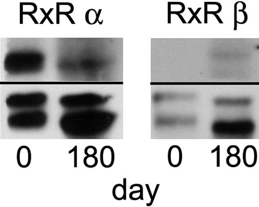 Figure 3. Expression of RXR-α and RXR-β subunits before therapy and after relapse of disease. Western blot analysis of protein extracts from patient PBMCs collected at day 0 before therapy and day 180 after initiating therapy revealed marked down-regulation of RXR-α protein after bexarotene therapy. Expression of both proteins was normalized to β-actin.