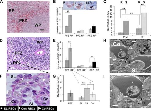 Figure 4. Analysis of P falciparum–iRBC deposition in the human spleen. (A,B) Mean (SEM) number of iRBCs/100 RBC in the perifollicular zone (PFZ) or in the red pulp (RP) for ring-iRBCs (R, in PFZ, in RP), schizont-iRBCs (S, in PFZ, in RP), or extra-erythrocytic parasite remnants (EER, in PFZ, in RP) subpopulations (mean from 6 isolated-perfused human spleen experiments, Giemsa-stained sections; WP indicates white pulp). Bar represents 50 μm. Typical aspects of each parasite development stage are shown on the inserts (middle column). (C) Retention index (RI = (“number of iRBCs/100 RBCs” as in panel B)/(circulating parasitemia at the end of the corresponding experiment)) for ring-iRBCs (R) or schizont-iRBCs (S) either in the PFZ or in the RP. An RI of 1 (black dotted line) corresponds to absence of retention. (D,E) Same approach as in panels A,B, but using PAS staining (a indicates central artery). (F) Purple PAS-stained section (bar represents 5 μm) showing the basal membrane of venous sinuses. Working classification of RBC deposition in the spleen red pulp: in the sinus lumen (SL), in the cords in direct contact with the sinus wall basal membrane (cordal abluminal, CoA), or in the cords but without contact with the basal membrane (cordal stricto sensu, Co). (G) RI for ring-iRBCs using the working classification of RBC deposition in the RP defined in panel F. (H,I) Transmission electron microscopy of a human isolated-perfused spleen sample showing a ring-iRBCs (white star) and an uninfected RBC (black star) upstream and downstream of an interendothelial slit (black arrows), respectively. This disposition reflects the cord- (Co) to-sinus lumen (SL) circulation of RBC in the spleen red pulp. The knobless membrane of the ring-iRBC is very close to the sinus wall basal membrane (white arrows). *P < .05, **P ≤ .01, #P < .001, statistically significant difference.