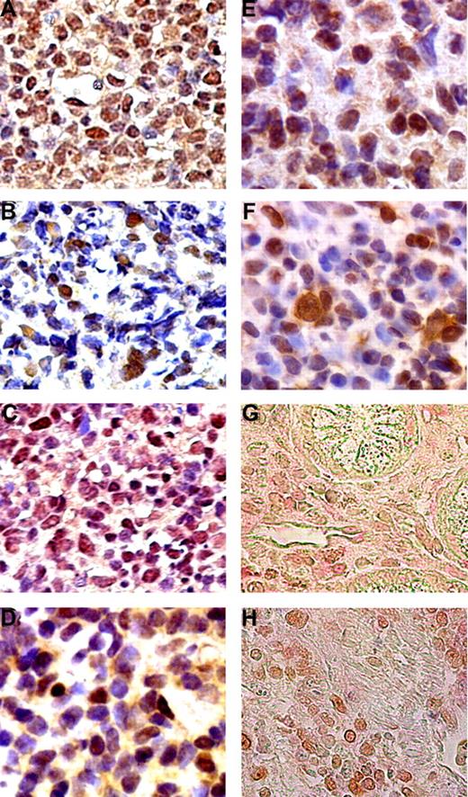 Figure 1. Expression of TNF-α, pAKT, BAFF, BCL3, BCL10, and NF-κB in gastric DLBCL (MALT) tumors. Aberrant expression of TNF-α (A), pAKT (B), and BAFF (C), and nuclear expression of BCL3 (D), BCL10 (E), and NF-κB (F) in the tumor cells of H pylori–independent gastric DLBCL (MALT) lymphoma patients. Double immunohistochemical staining showed that (G) tumor cells with BAFF nuclear staining (brown) are also CD20+ (red). (H) Tumor cells expressing pAKT staining (brown) are also CD20+ (red).