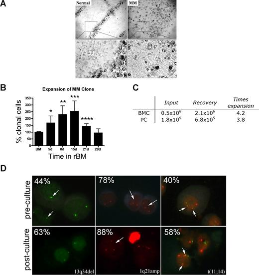 Figure 3. MM rBM has an abnormal tissue architecture and exhibits clonal expansion of MM cells with chromosomal abnormalities. (A) BMCs from normal donors (n = 5) and MM patients (n = 10) were grown in rBM for 21 days followed by assessment of the overall culture architecture by brightfield microscopy (top, original magnification 50×; bottom, original magnification 200×). Cells localized to “tracks” are TRAP+ osteoclasts (not shown). Representative images are shown with the plane of focus set to the bottom of the plate representing reconstructed endosteum. (B) BM cells (n = 16 patients) were grown in rBM for the indicated number of days, and the extent of the malignant outgrowth of the MM clone was measured by RQ-PCR using patient specific primers. Each malignant cell has only one copy of the IgH VDJ rearranged template; RQ-PCR determines the number of rearranged IgH VDJ templates compared with a β2-microglobulin standard curve and an IgH VDJ positive control curve. Percent clonal cells corresponds to the percentage clonal VDJ templates present in the sample normalized to the β2-microglobulin gene (*P = .006, **P = .001, ***P = .002, ****P = .003). Error bars represent SEM. (C) Absolute numbers of BMCs and PCs, which were originally placed into and recovered from rBM (mean values for 3 different patients). (D) FISH analysis of cells harvested from 3-D culture. Cells from 3-D cultures were screened for the chromosomal abnormalities (marked with arrows, and percentage plasma cells with each abnormality stated at the top left) detected in preculture BM PCs, using cytospins from the matching D21 rBM (n = 5 patients) stained by interphase FISH. Abnormal cells are indicated by arrows. (Left panel) PCs with a deletion of 13q34 locus (1 green signal) and a normal cell (2 green signals). (Middle panel) PCs with an amplification of 1q21 (3 red signals) and a normal cell (2 red signals). (Right panel) PCs with t(11;14) translocation with 2 derivative chromosomes (2 yellow signals), 1 normal chromosome 11 (1 red signal), and 1 normal chromosome 14 (1 green signal; original magnification 630×). For additional image acquisition information, see “Microscopy” and “Fluorescent in situ hybridization.”