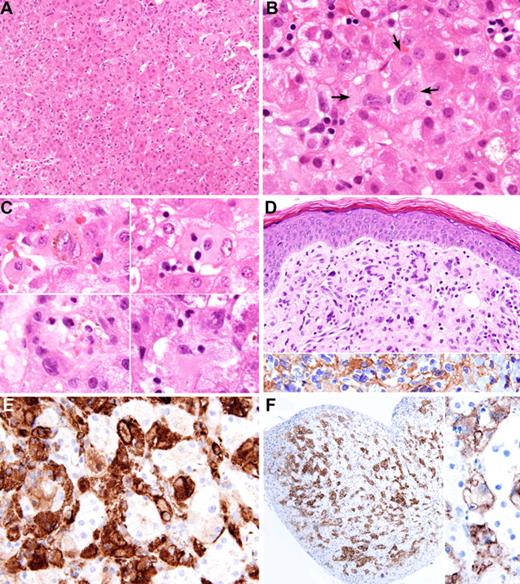Figure 1. Liver and skin biopsies. (A) Liver biopsy of case 2 shows infiltration of sinusoids by large histiocytes, which on causal examination are difficult to distinguish from the hepatocytes. (B) Liver biopsy of case 1 shows aggregates of histiocytes (arrows) in the sinusoids. The histiocytes have irregularly folded nuclei and abundant lightly eosinophilic cytoplasm. (C) Morphologic spectrum of proliferated histiocytes in the liver sinusoids. The histiocytes have 1 or 2 nuclei, which often show marked irregular foldings and small nucleoli. Some contain phagocytosed blood cells, brown pigment, or fine vacuoles. (D) Skin lesion of case 1 shows dermal infiltrate of mononuclear cells and multinucleated giant cells; the latter showed wreathlike nuclei (upper panel). These cells are immunoreactive for ALK (lower panel). (E) The histiocytes in the sinusoids show positive immunostaining for CD163. (F) Immunostaining for ALK highlights the sinusoidal distribution of the histiocytes (left panel). Higher magnification shows cell membrane and weak cytoplasmic staining (right panel). Images were captured with Olympus DP71 camera mounted on an Olympus microscope model BX61 (Tokyo, Japan). The objectives used for capturing the images were as follow: (A) 20× objective; (B) 100× objective; (C) 100× objective; (D) 40× objective; (E) 60× objective; (F, left) 10× objective; (F, right) 60× objective. Images were acquired using Olympus DP Controller, and whitening of the background and cropping of the images were performed using Adobe Photoshop CS (Adobe Systems, San Jose, CA).
