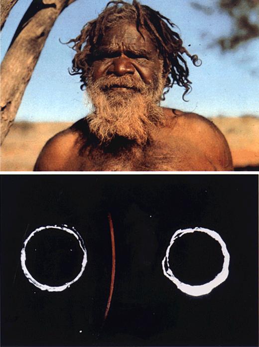 Figure 1. Au antigen discovery. An Australian aborigine (top) and the precipitin line formed between the aboriginal serum and that of a multiply transfused patient with hemophilia (bottom). The precipitin failed to stain for lipid, but stained red with the azocarmine counterstain for protein. Reprinted with permission of Nature Publishing Group from Alter HJ and Houghton M, Hepatitis C virus and eliminating posttransfusion hepatitis (Nat Med. 2000;6:1082-1086).
