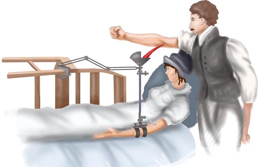 Figure 3. Sketch of Blundell's gravitator. Blood from the donor dripped into a cup fixed several feet above the arm of the recipient and was directed through tubing into the recipient's vein. Adapted from Blundell J, Observations on transfusion (Lancet. 1828;2:321) with permission from Elsevier. Illustration by Marie Dauenheimer.