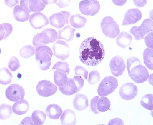 A 62-year-old man was diagnosed with breast cancer by a fine needle biopsy. The family history was negative for breast cancer. He and his wife had no children. When they were evaluated years earlier, he was noted to be infertile. Currently, the physical examination showed a lanky individual with mildly prominent hips, gynecomastia, and pea-sized firm testicles. The peripheral blood smear showed a small nodule of chromatin separated from the main nuclear lobe by a strand of chromatin (“drumsticks”) in approximately 3% of the polymorphonuclear leukocytes. / Drumsticks usually appear when two XX chromosomes are present. Women have drumsticks in 3% or more of the polymorphonuclear leukocytes. The active X chromosome is randomly distributed within nuclear lobes, but the inactive X preferentially appears in drumsticks. Typical drumsticks are rarely seen in normal men. Drumsticks should be differentiated from other nuclear appendages (sessile nodules, small clubs, small lobe, rackets) that may occasionally be seen in both sexes. / This patient was infertile, had small testicles, and drumsticks that suggested Klinefelter syndrome (XXY chromosomes). The chromosome analysis confirmed XXY. Patients with Klinefelter syndrome often have gynecomastia, low testosterone levels, and elevated FSH and LH. Studies also suggest that patients with Klinefelter syndrome have an increased tendency to develop breast cancer, the frequency of which is greater than that seen in normal (XY) males, but less frequency than in true females.