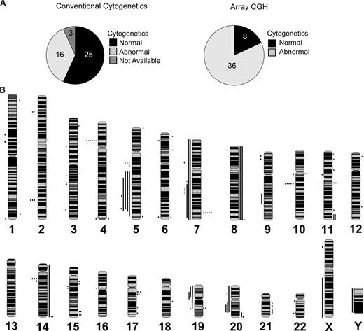 Figure 1. Array CGH detects cryptic alterations in MDS patients with normal cytogenetics. (A) Proportion of patients with abnormal cytogenetics as detected by conventional cytogenetics (left) and by aCGH (right). (B) Whole genome frequency distribution of chromosomal alterations in lower-risk patients (n = 44) as detected by aCGH and visualized by SeeGH. Lines to the right of the chromosome indicate gain of chromosomal material. Lines to the left of the chromosome indicate loss of chromosomal material.