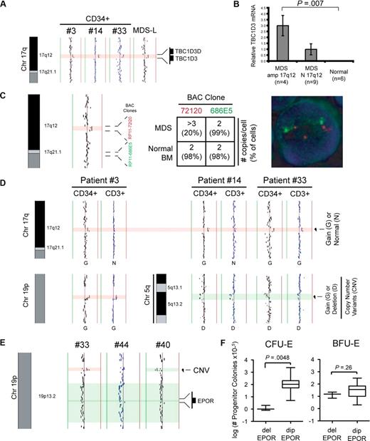 Figure 2. Detection of alterations at bands 19p13.2 and 17q12 by aCGH. (A) Alignment of aCGH profiles at chromosome 17q12 from 3 patients (3, 14, and 33) and 1 human MDS cell line (MDS-L). (B) Relative expression of TBC1D3 mRNA in MDS marrow samples from patients with (n = 4) and without (n = 9) amplification at band 17q12, as well as normal controls (n = 6) by quantitative reverse-transcribed polymerase chain reaction. (C) aCGH profile of the MDS cell line (MDS-L) at chromosome 17q12 showing position of the BAC clones used for FISH analysis of the MDS-L cell line (left). The average number of copies per cell (and proportion of total cells) as detected is tabulated (middle), and FISH analysis using BAC probes RP11-72I20 (red, within region of interest) and RP11-686E5 (green, outside region of interest) is shown on a representative cell (right). (D) Alignment at chromosome 17q, 19p, and 5q is shown to compare matched CD34+ and CD3+ profiles from 3 MDS patients (3, 14, and 33). Alterations at chromosomes 19p (patient 3) and 5q (patients 14 and 33) are within known polymorphic (CNV) regions and are used as an internal control. (E) Deletion encompassing the EPO receptor (EPOR) at chromosome 19p13.2 is seen in 3 patients (33, 40, and 44). Approximate boundaries of the EPO receptor locus and a CNV are highlighted. Vertical lines denote log2 signal ratios from −1 (green) to + 1 (red). Green shading delineates the borders of a deletion. Red shading delineates the borders of an amplification. (F) Erythroid progenitor colony assays were performed at the time of diagnosis. Comparison of CFU-E and BFU-E progenitor colony assays is shown for MDS patients with deletion of the EPOR locus (del EPOR; n = 3) and patients with a diploid EPOR locus (dip EPOR; n = 41).
