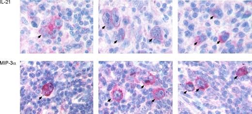 Figure 4. Immunohistology of IL-21 and MIP-3α in primary HL cases. Immunohistology of representative HL specimens stained for IL-21 (top row) and MIP-3α (bottom row) is shown. HRS cells are marked by arrows. Magnification, 110×.