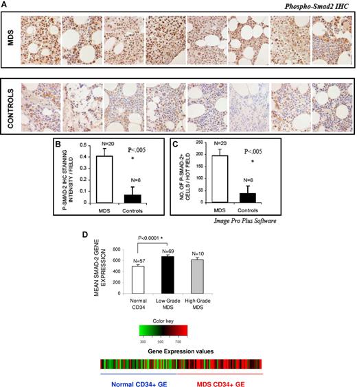 Figure 1. smad2 is activated in MDS. Bone marrow (BM) biopsies from patients with MDS and controls with non-MDS causes of cytopenias were fixed and immunostained with antibody against phospho-smad2 (A). Histologic examination reveals more intense staining in MDS samples. Eight representative samples of MDS and controls are shown in panel A. The quantification of p-smad2 staining was analyzed by counting the total number of positively stained cells (B) and by measuring intensity of the positively stained cells (C) in 5 hot fields (which is defined as area of high density of p-p38 staining) and aided by Image Pro Plus (Nikon, 400×). Two-tailed t test shows significantly higher smad2 activation/field in MDS samples. Differences in smad2 expression were also evaluated in normalized meta-analysis of MDS CD34+ (69 cases)– and normal CD34+ (57 cases)–cell–derived gene expression microarray studies. Smad2 gene expression was significantly up-regulated in low-grade MDS bone marrow CD34+ cells (2-tailed t test) (D). Error bars represent SEM.