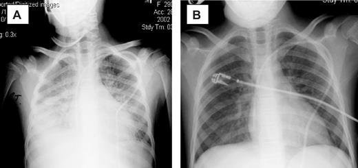 Figure 1. Chest radiographs of patient 5. (A) Before therapy. (B) On therapy. Panel A was obtained on day 0 of study, with the patient requiring 100% FiO2 via bilevel positive airway pressure (BiPAP). Panel B was obtained 3 days later, with the patient now off all supplemental oxygen support.