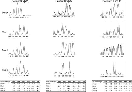 Figure 1. Representative CDR3-size spectratype analysis of a Vβ family from 3 donor/patient pairs. Spectratype histograms were generated from donor PBLs, the MLC, and 2 posttransplantation samples for each Vβ shown. The area under each peak matching the PCR basepair (bp) product length is determined by the software program as described in “CDR3-size spectratype analysis” and is indicated in the table as a percentage of the total histogram. A peak within a spectratype is compared with its corresponding peak in the donor sample and is considered to be skewed (indicated in bold italics) if the percentage area is at least 2-fold that of the donor.