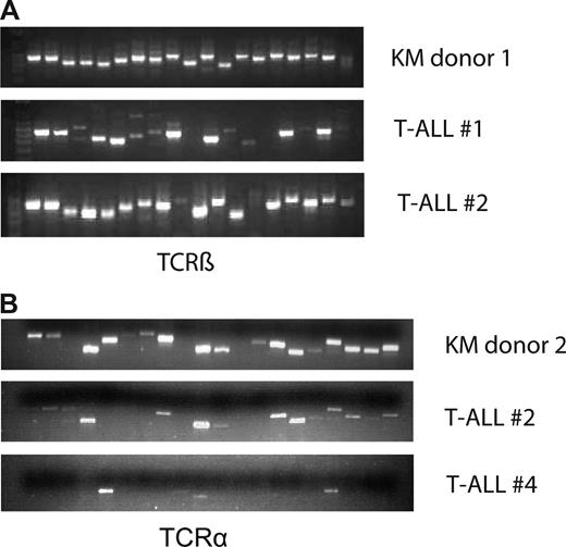 Figure 3. T-cell disease is oligoclonal. Analysis of TCR-β rearrangement. Thymocyte/tumor cDNA was amplified using primer pairs specific for each of the 19 and 20 possible variable/constant region junctions at the murine TCR-β locus (A) and TCR-α (B) locus, respectively. The samples were electrophoresed through a 1.8% agarose gel and stained with ethidium bromide. Top line represents KM donor; middle and bottom lines, 2 different tumor samples.