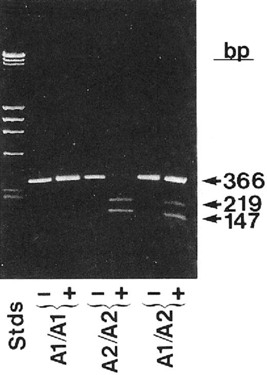 Figure 4. Application of reverse transcription and the polymerase chain reaction to identify the PlA1 polymorphism as due to a nucleotide mutation leading to a Leu33Pro substitution in the integrin β3 subunit. Bases 56-408 of integrin β3 were enzymatically amplified from individuals who were homozygous PlA2 or heterozygous PlA1/PlA2 and analyzed on agarose tells. The enzyme is sensitive to the T→C change in the sequence at base 196 associated with the PlA2 polymorphism. Reprinted with permission from Newman et al. J Clin Invest. 1989;83:1778-1781.84