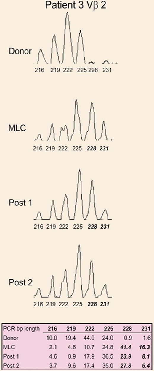 A representative CDR3 size spectratype analysis of the Vβ2 family from the donor, donor/patient mixed lymphocyte culture, and at 2 time points after allogeneic HSCT. See the complete figure in the article beginning on page 3517.
