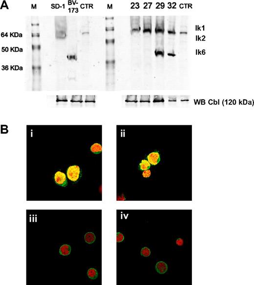 Figure 2. Ikaros protein expression and compartmentalization. (A) Anti-Ikaros Western blots of whole cell lysates from leukemic cell lines (SD-1 and BV-173), leukemic bone marrow mononuclear cells from Ph+ ALL at diagnosis (ID 23, ID 27, ID 29, and ID 32). As a control, we used a Jurkat cell nuclear extract. The positions corresponding to the migration patterns of Ik-1 (∼ 57 kDa), Ik-2 (∼ 47 kDa), and Ik-6 (∼ 37 kDa) proteins are indicated. Anti-Cbl Western blots of the whole cell lysates were performed as controls. (B) Expression and subcellular localization of Ikaros proteins in leukemic cells from Ph+ ALL patients. In all images, cells were stained with an Ikaros antibody (green) and with propidium iodide (red) to visualize the DNA. (Bi,ii) Confocal images of leukemic cells from patients expressing full-length Ikaros isoforms showed the characteristic multifocal nuclear localization pattern of Ikaros. (Biii,iv) Confocal images of leukemic cells express the Ik6 isoform and show cytoplasmic expression of Ikaros (eg, bright green fluorescent rim surrounding the toto-labeled red nuclei).