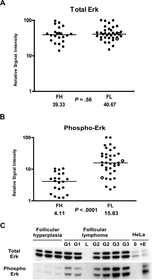 Figure 3. Erk activation in follicular lymphoma. (A,B) Tissue lysates of FL (N = 36) and FH (N = 22) were printed on RPMAs and probed with antibodies for Erk (A) and phosphorylated Erk on Thr202/Tyr204 (B), as described in “Methods.” Scatterpoints represent relative signal intensity averaged over 3 runs and are depicted on a log10 scale. Median group values for FL and FH are designated with horizontal bars on the scatterplots and are listed beneath each plot, with the P value for comparison of the 2 groups. FL samples representing grade 3B are indicated by ○. (C) A total of 6 samples of FL (G1 indicates grade 1; G2, grade 2; G3, grade 3A) were compared with 3 samples of FH on Western blot, using antibodies for detection of total Erk and phospho-Erk Thr202/Tyr204. Serum-starved HeLa cells (0) and HeLa cells treated with epidermal growth factor (+E) served as negative and positive controls for Erk activation. L represents the lane used for the molecular weight ladder.