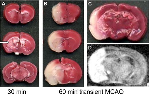 Figure 1. Transient middle cerebral artery occlusion model (tMCAO) in the mouse. (A,B) Three coronal sections through the brain in individual animals. (A) A cerebral infarct at 24 hours after 30 minutes of tMCAO and (B,C) after 1 hour of tMCAO as revealed on tissue sections stained for 2,3,4-triphenyltetarzoliumchloride (TTC), a mitochondrial marker. Red areas represent vital brain tissue; white areas indicate cerebral infarctions. With short occlusion times of 30 minutes, infarcts are restricted to the basal ganglia (arrow in A), whereas prolonged occlusion leads to infarction of the entire MCA territory (B). (D) Infarct development can also be assessed in vivo by magnetic resonance imaging (MRI). Infarcts appear white on T2-w or diffusion-weighed MRI (D) and correspond closely to the extent of infarction seen on tissue sections (C). TTC scans were taken from an Epson Perfection 3200 Photo flatbed scanner (Seiko Epson, Nagano, Japan) at 600 dpi and processed using Epson Scan software. MRI was performed on a 17.6-Tesla ultrahigh field MR unit (Biospin; Bruker BioSpin, Ettlingen, Germany) using a custom-made dual channel surface coil designed for the examination of mouse heads (A063HACG; Rapid Biomedical, Würzburg, Germany). The image protocol comprised a coronal diffusion–weighted sequence (slice thickness, 0.5 mm). MR images were transferred to an external workstation (Leonardo; Siemens, Berlin, Germany) for data processing.