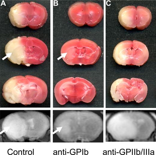 Figure 3. The influence of platelet glycoprotein receptor blockade on stroke outcome. (A) Coronal 2,3,4-triphenyltetarzoliumchloride–stained sections at 24 hours after 1 hour of tMCAO in a sham-treated mouse. Note the large infarction of the entire middle cerebral artery territory, and the corresponding T2-w magnetic resonance image of the infarct in the bottom panel. (B) Blockade with anti-GPIb Fab significantly reduced infarct size. The arrow points to the small infarct within the basal ganglia, whereas the cerebral cortex is protected. The corresponding magnetic resonance image correctly depicts decreased infarct size (arrow in bottom panel). (C) Surprisingly, blockade of GPIIb/IIIa had no influence on the infarct size in surviving animals, and was associated with lethal intracerebral hemorrhage (ICH) in many animals (not shown). Importantly, no areas with signal loss indicating bleeding complications were seen in mice after GPIb-Fab blockade (bottom panel in B; compare with ICH in Figure 2C). TTC scans were taken from an Epson Perfection 3200 Photo flatbed scanner (Seiko Epson) at 600 dpi and processed using Epson Scan software (Seiko Epson). MRI was performed on a 1.5-Tesla MR device (Vision; Siemens) using a custom-made dual channel surface coil designed for the examination of mouse heads (A063HACG; Rapid Biomedical). The image protocol comprised a coronal 3D T2-weighted gradient echo–constructed interference in steady state sequence (slice thickness, 1 mm). MR images were transferred to an external workstation (Leonardo; Siemens) for data processing.