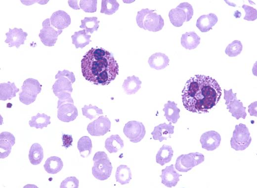 A 28-year-old woman was seen for lethargy by her primary care physician. A complete blood count was obtained, and the report indicted mild anemia and toxic granulation of neutrophils. Although she was afebrile, a course of antibiotics was given but without any benefit. A referral for mild anemia was made to a hematologist. / Her medical history included normal menses, no other blood loss, and 2 previous uncomplicated pregnancies. The family history was unremarkable. The peripheral smear was reviewed (see figure), and toxic granulation was affirmed. However, “burr”-shaped red cells were also seen. / Toxic granulation can be associated with infection and inflammation. Increased granulation of neutrophils may also be present in some genetic disorders, following treatment with myeloid growth factors (G-CSF or GM-CSF), in a marrow responding to myelosuppressive therapy, with pregnancy, and in uremia. The combination of disfigured red cells and toxic granulation raised the possibility of renal failure. Additional laboratory work affirmed azotemia, accompanied by mildly elevated phosphorus and lowered calcium.