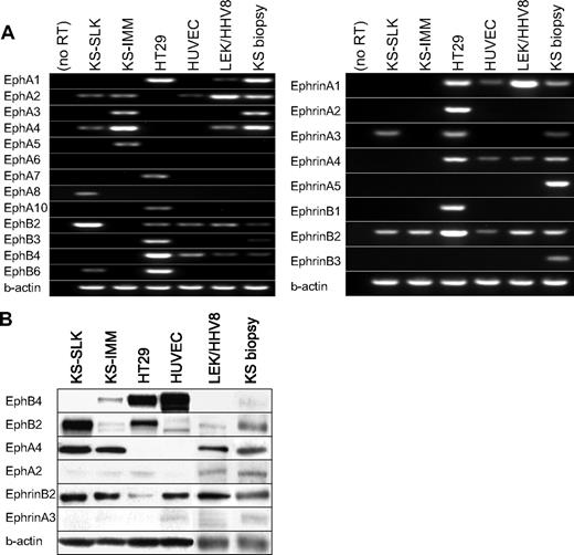 Figure 1. The Eph and Ephrin expression in KS cell lines KS-SLK and KS-IMM, lymphatic endothelial cells transformed with HHV-8 (LEC/HHV-8), and KS tumor biopsy. (A) The mRNA expression of 13 Eph receptors and 8 Ephrin ligands was determined with RT-PCR. HT29 colon cancer cell line and HUVEC were included as controls. (B) Western blot analysis to for protein expression of selected expressed Eph-Ephrins. β-actin expression was done to show comparable protein loading.