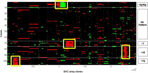 Figure 4. Cluster analysis of BAC array clones from the 71 regional aberrations in 106 cases. The K-medoids algorithm (where K = 5) was applied to cluster both 106 cases (x axis) and 4912 BAC clones derived from 71 regions of aberrations. Four distinct clusters, +1q, +6p and 6q−, +7, and +18, were identified. The rest exhibited no obvious pattern of aberrations.