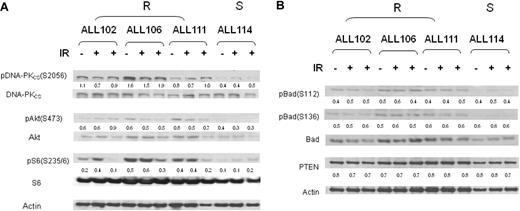 Figure 5. Differential phosphorylation of PI3-kinase/Akt pathway during IR response in apoptosis-resistant ALLs. (A) Increased phosphorylation at 0 hours, 30 minutes, and 4 hours after IR of DNA-PK at serine 2056, Akt at serine 473, and ribosomal protein S6 at serine 235/6 in apoptosis-resistant ALL tumors (102, 106, and 111) compared with the representative apoptosis-sensitive tumor ALL 114. (B) Comparable phosphorylation of Bad at residues serine 112 and 136 and expression of PTEN protein at 0 hours, 4 hours, and 8 hours after IR in apoptosis-resistant ALL tumors (102, 106, and 111) compared with the representative apoptosis-sensitive tumor ALL 114. Numerical values represent expression ratios of the phosphorylated-total protein for DNA-PKCS, Akt, S6, and Bad, and protein/actin for PTEN. R indicates apoptosis-resistant ALL; S, apoptosis-sensitive ALL.