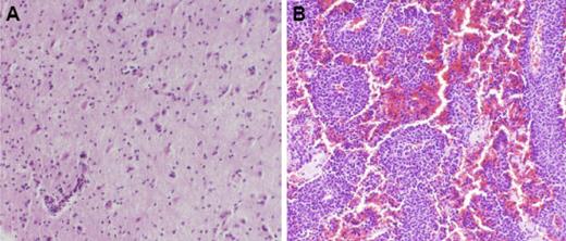 Figure 1. Low- and high-density PCNSL tumors. Low-density (A) and high-density (B) PCNSL tumors, each of large B-cell histology, are distinguished by the presence (A) or absence (B) of intervening normal brain elements between the tumor cells in pathologic specimens. Magnification ×100 (hematoxylin and eosin). Image were photographed using an Olympus Vanox AHBT3 microscope with Olympus DP70 digital camera (Olympus Optical, Tokyo, Japan). Images were captured onto a personal computer using Olympus DP controller software, version 1.2.1.108.