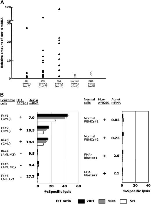 Figure 3. Expression of Aur-A in freshly isolated leukemia cells and the cytotoxicity of AUR-1 against freshly isolated leukemia cells. (A) Expression of Aur-A mRNA in freshly isolated leukemia cells, normal PBMCs, and PHA-stimulated T lymphocytes. Expression levels of Aur-A mRNA in freshly isolated leukemia cells and normal cells were determined using samples obtained from 7 patients with ALL, 17 patients with AML, 10 patients with CML in chronic phase, 4 healthy individuals, and PHA-stimulated T lymphoblasts obtained from 3 healthy individuals. To prepare PHA-stimulated T lymphoblasts, PBMCs were cultured in RPMI 1640 medium supplemented with 10% FCS and PHA at an appropriate concentration for 4 days. The level of Aur-A mRNA in normal PBMCs is shown as 1.0 and the expression levels in samples were calculated relative to this value. (B) Cytotoxicity of AUR-1 against freshly isolated leukemia cells and normal cells. The cytotoxicity of AUR-1 against HLA-A*0201–positive and HLA-A*0201–negative freshly isolated leukemia cells, HLA-A*0201–positive normal PBMCs, and HLA-A*0201–positive normal PHA-stimulated T lymphoblasts was determined by 51Cr-release assays at E:T ratios of 20:1, 10:1, and 5:1. Expression levels of Aur-A mRNA in samples are also shown.