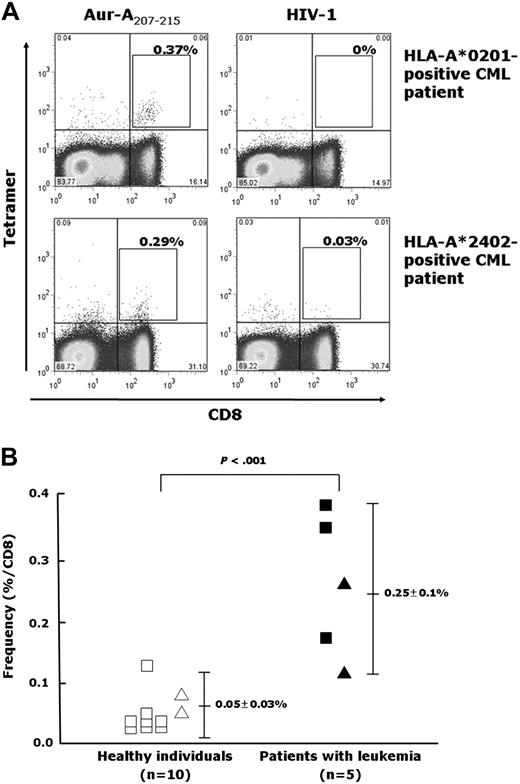 Figure 5. Detection of Aur-A207-215–specific CTL precursors in patients with leukemia. (A) Representative data of the tetramer assay for Aur-A207-215–specific CTL precursors. PBMCs isolated from HLA-A*0201–positive and HLA-A*2402–positive patients with CML in chronic phase were stimulated with Aur-A207-215 peptide and then stained with HLA-A*0201/Aur-A207-215 tetramer and HLA-A*2402/Aur-A207-215 tetramer, respectively. HLA-A*0201/HIV-1 p17 Gag77-85 (SLYNTVATL) tetramer and HLA-A*2402/HIV-1 Env584-592 (RYLRDQQLL) tetramer were used as negative controls. (B) Summary of tetramer assays for Aur-A207-215–specific CTL precursors. PBMCs isolated from 3 HLA-A*0201–positive patients with leukemia (a patient with AML in complete remission after allogeneic stem cell transplantation, a patient with ALL in complete remission after chemotherapy, and a patient with untreated CML in chronic phase; ■), 2 HLA-A*2402–positive patients with leukemia (2 patients with CML in chronic phase after therapy with interferon or imatinib; ▴), 8 HLA-A*0201–positive healthy individuals (□), and 2 HLA-A*2402–positive healthy individuals (▵) were stained with HLA-A*0201/Aur-A207-215 or HLA-A*2402/Aur-A207-215 tetramer. The frequency of Aur-A207-215–specific CTL precursors in the patients with leukemia was significantly higher than that in healthy individuals (Student t test; P < .001).