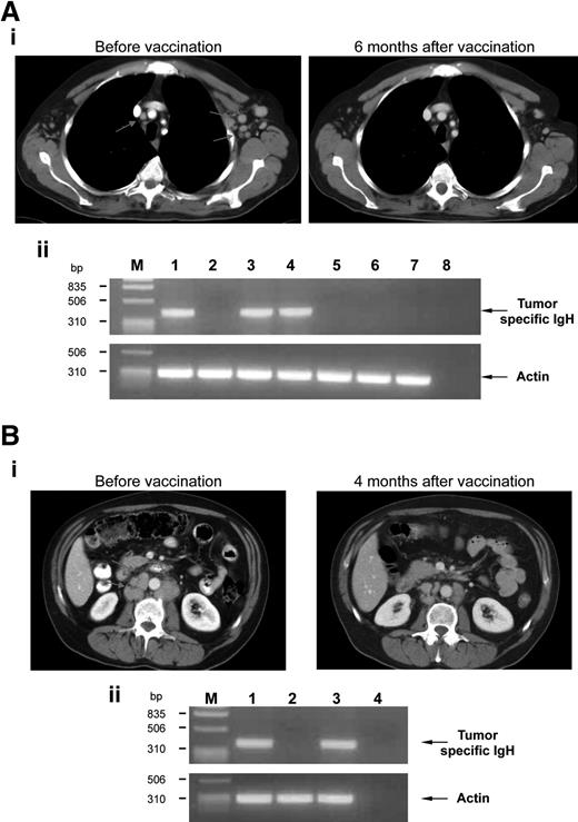 Figure 1. Therapeutic effects of vaccination. (A) Example of a clinical CR. (i) CT scan images of the chest of patient no. 12 revealed multiple small enlarged mediastinal and left axillary LNs (left, arrows) that normalized 6 months after vaccination (right). (ii) Involvement of BM (lanes 1 and 2: before vaccination and 6 months after vaccination, respectively) and PB (lanes 3, 4, 5, 6, and 7: before vaccination, and 3, 6, 12, and 18 months after vaccination, respectively) was evaluated by PCR amplification of the clonal tumor-specific IgH gene rearrangement using IgH-specific molecular probe. Actin amplification was performed as a control. Line 8 represents no DNA; M, marker. (B) Example of a clinical PR. (i) CT scan images of the retroperitoneum of patient no. 5 showed enlarged retroperitoneal LNs (left, arrows) that shrunk 4 months after vaccination (right). (ii) Involvement of BM (lanes 1, 2, and 3: before vaccination, and 4 and 12 months after vaccination, respectively) was evaluated by PCR amplification for panel A. Actin amplification was performed as a control. Line 4 represents no DNA; M, marker.