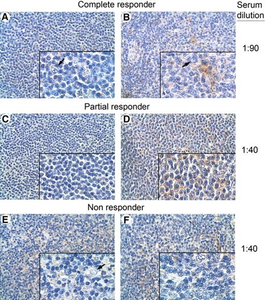 Figure 6. Immunohistochemical analysis of tumor biopsies with autologous serum. Immunohistochemical analysis of NHL specimens, with a homogeneous population of small lymphoid cells from a complete (A,B), a partial (C,D), and a nonresponding patient (A-F), immunostained with biotin-conjugated autologous prevaccination (A,C,E) and postvaccination (B,D,F) serum samples at the indicated serum dilutions. Lymphoid neoplastic cell-restricted autoreactivity was evidenced only when the postvaccination sera of the complete (B) and the partial (D) responders were used. No tumor-restricted immunostaining was detected either in prevaccination (E) or postvaccination (F) serum samples of a nonresponding patient. Nonneoplastic follicular DCs and endothelial cells present in the inset of panels A, B, and E showed no immunostaining (). Panel insets are shown at ×40 original magnification; panels, at ×10 original magnification. Images were acquired using Leica DMD108 (Heidelberg, Germany) equipped with HI Plan 10×/0.25 and 40×/0.65 objectives and processed in Adobe Photoshop CS3 software (San Jose, CA).