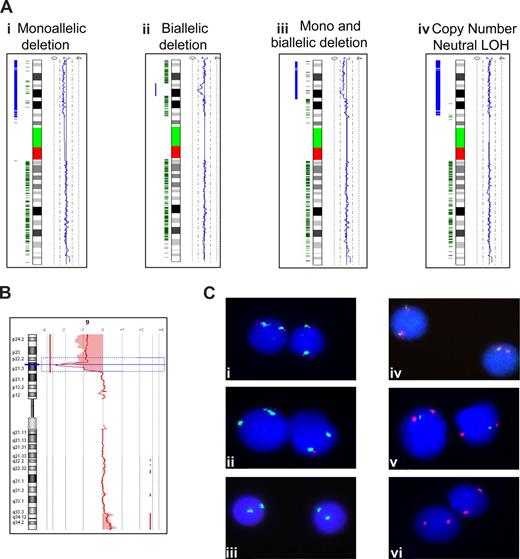 Figure 1. Genomic mapping of chromosome arm 9p. (A) Profiles generated using the copy number analyzer for Affymetrix GeneChip software. Ideograms of chromosome 9 are positioned vertically and flanked by a blue copy number plot to the right, which follows 2.0 for normal copy number. To the left of each ideogram, heterozygous SNP calls are shown in green, and the likelihood of LOH is represented by the thickness of the blue bar. Thus, the 4 profiles show a patient with (i) a monoallelic terminal deletion of 9p, (ii) an interstitial biallelic deletion, (iii) both a terminal monoallelic and interstitial biallelic deletion, and (iv) CNN LOH. (B) An array CGH profile for chromosome 9. The chromosome ideogram is positioned vertically with the red line following a log ratio of 0.0 for normal copy number. This profile shows a patient with a terminal monoallelic and interstitial biallelic deletion. The shaded areas define regions of copy number change ac-cording to a z-score algorithm. (C) FISH analysis. Vysis p16(9p21) (red)/CEP9 (green) probe showing (i) normal pattern, (ii) monoallelic deletion, or (iii) biallelic deletion. WRGL CDKN2A (green)/Centromere 9 (red) deletion probe showing (iv) normal pattern, (v) monoallelic deletion, or (vi) biallelic deletion.