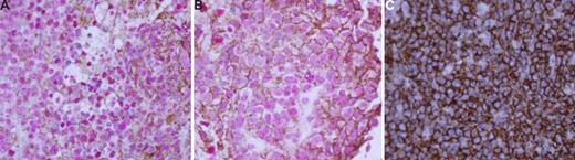 Figure 1. CD20 and osteopontin are coexpressed in PCNSL. Dual immunohistochemistry was performed using antibodies specific to CD20 (Dako, Carpenteria, CA) and osteopontin (R&D Systems, Minneapolis, MN). Diaminobenzidine (brown) dye (Dako) was used for CD20 and Vulcan fast red (red) dye (Biocare Medical, Concord, CA) was used for osteopontin. (A) PCNSL. Original magnification ×400. Both CD20 (membranous pattern) and osteopontin (predominantly nuclear) are clearly positive. (B) Second case of PCNSL. Original magnification ×1000. Again, both CD20 and osteopontin are positive. (C) Nodal DLBCL. Original magnification ×400. Only CD20 is positive with no expression of osteopontin. A Leica DMLB optical microscope (Leica Microsystems, Wetzlar, Germany) and Cytoseal-60 mounting media (Richard Allen, Kalamazoo, MI) were used. Images were acquired using a SPOT RT Color Camera (Diagnostic Instruments, Sterling Heights, MI), and were processed with SPOT Advanced program version 2.0 (Diagnostic Instruments) and Adobe Photoshop version 6.0 software (Adobe Systems, San Jose, CA).