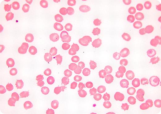 54-year-old man was seen in the emergency room with abdominal discomfort and peripheral edema. His referring physician affirmed a prior history of alcoholism, accompanied by mild anemia and target cells on his peripheral smear. When examined in the emergency room, he had jaundice, ascites, lower extremity edema, a slightly enlarged liver, and a moderately enlarged firm spleen. Stool was hemoccult negative. / Laboratory tests revealed marked anemia (hemoglobin 68 g/L) and moderate thrombocytopenia. The reticulocyte count was elevated at 7.5%. Peripheral smear (shown) had red cells with numerous spicules irregularly distributed over the membrane surfaces. Total bilirubin was markedly elevated with an increase in indirect bilirubin. Haptoglobin was very low and the Coombs test was negative. / A history of alcoholism and liver disease combined with current findings of enlarged spleen, hemolytic anemia, and a peripheral blood smear showing spiculated red cells are consistent with spur cell anemia. Spur cells have increased membrane cholesterol, increased cholesterol-to-phospholipid ratio, and membrane rigidity. Normal red cells may acquire these features after transfusion into a patient with spur cell anemia and undergo similar changes after incubation in vitro with patients' serum or with lipid mixtures containing a high cholesterol-to-phospholipid ratio. This disorder heralds rapid clinical deterioration due to progressive liver failure. Splenectomy may improve the hemolysis by eliminating the site of sequestration of spur cells, but it carries a high risk of complications and does not improve the underlying liver disease. Liver transplantation has been reported to reverse the disease process and eliminate the spur cells.