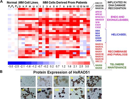 Figure 2. Elevated expression of HR-related genes in MM cells. (A) Gene expression profile was measured in 3 normal plasma cell isolates (P1, P2, P3), 6 myeloma cell lines (D indicates ARD; K, ARK; P, ARP; M, MM1s; U, U266; and 8, RPMI8226), and 15 purified myeloma cells from patient bone marrows (1-15) with the use of HG-U133 gene arrays. The color scale at the bottom of the figure represents fold change in recombination- and repair-associated genes in myeloma cells relative to average expression in 3 normal plasma cell samples. (B) Protein levels of HsRAD51 and its paralogs were detected by immunostaining, with either a polyclonal antibody against HsRAD51, also recognizing RAD51B and RAD51C or monoclonal antibodies recognizing HsRAD51 or its paralogs individually. (i) Normal plasma cells, no primary antibody control; (ii) normal plasma cells (donor 1), HsRAD51/51B/51C; (iii) normal plasma cells (donor 2), HsRAD51/51B/51C; (iv) ARP myeloma cell line, HsRAD51/51B/51C; (v) MM1S myeloma cell line, HsRAD51/51B/51C; (vi) U266 myeloma cell line, HsRAD51/51B/51C; (vii) patient myeloma cells, HsRAD51; (viii) patient myeloma cells HsRAD51B; (ix) patient myeloma cells, HsRAD51C; and (x) patient myeloma cells, HsRAD51D.