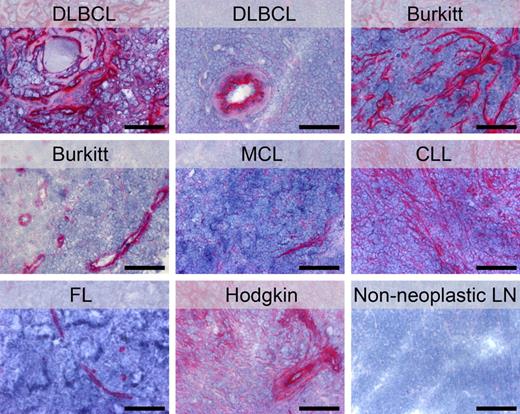 Figure 7. Expression of EDB fibronectin in human lymphomas. Immunohistochemical analyses of cryosections from human lymphoma specimens with the L19 antibody revealed EDB expression in both aggressive and indolent NHLs and in Hodgkin lymphoma. In contrast, no or only very faint staining was observed in non-neoplastic lymph nodes. While the pattern of EDB staining appeared strictly vascular in the majority of the lymphoma cases, a diffuse stromal reaction was observed in some specimens (as exemplified with the CLL sample). DLBCL, diffuse large B cell lymphoma; MCL, mantle cell lymphoma; CLL, chronic lymphocytic leukemia; FL, follicular lymphoma; LN, lymph node. Scale bars, 100 μm.