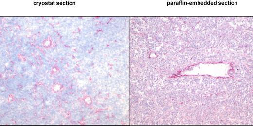 Figure 1. ED-B FN expression is similarly detectable in cryostat and paraffin-embedded tissues by immunohistology. Cryostat and paraffin-embedded specimens stemmed from the same lymph node biopsy of a patient with follicular lymphoma grade 2. One-half of the biopsy was shock-frozen, whereas the other half was paraffin-embedded. Both specimens were stained with the anti–ED-B FN MX1 antibody (magnification of the left panel: ×30; magnification of the right panel: ×50).