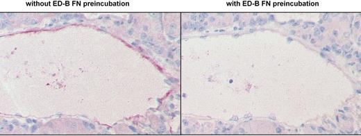 Figure 2. Competition of ED-B FN staining by soluble recombinant ED-B FN. ED-B FN immunostaining was performed on paraffin-embedded serial sections of a clear cell renal cell carcinoma, using L19IL2, with (right) or without (left, positive control) preincubation of L19IL2 with an excess of soluble recombinant ED-B (magnification: ×150).