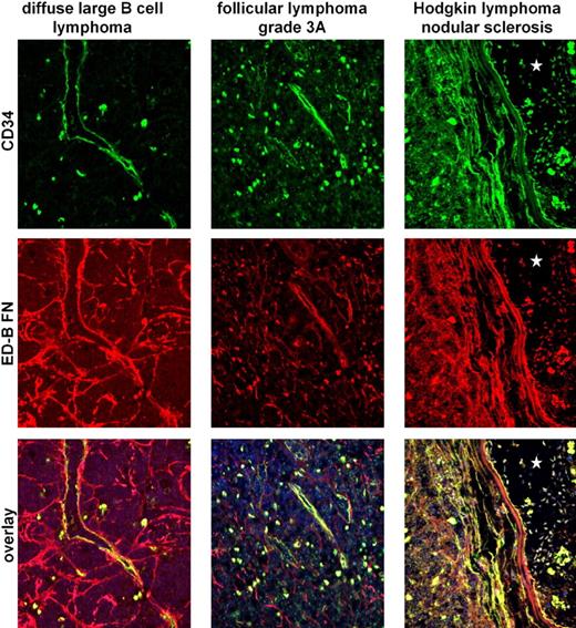 Figure 3. Double fluorescence staining of CD34+ endothelia (green label) and ED-B FN (red label) indicates colocalization of both antigens. The colocalization of CD34+ endothelia and ED-B FN was investigated by double fluorescence confocal microscopy of paraffin-embedded specimens of diffuse large B-cell lymphoma, follicular lymphoma (Grad 3a), and classic Hodgkin lymphoma. Colocalization of ED-B FN and CD34+ endothelia was found as indicated by the yellow label. Nuclei were stained blue (TOTO3). The asterisks in the right panels (classic Hodgkin lymphoma) indicate a large vessel lumen.