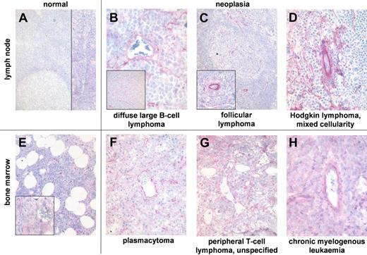 Figure 4. ED-B FN expression is abundant in biopsies of hematologic malignancies. ED-B FN expression of paraffin-embedded specimens of normal lymph node (A; magnification: ×100, left inset: ×20), and lymph node biopsies of diffuse large B-cell lymphoma (B; ×250, inset ×20); follicular lymphoma grade 2 (C; ×20, inset ×100), and classic Hodgkin lymphoma of mixed cellularity subtype (D; ×150). ED-B FN expression of bone marrow biopsies of normal bone marrow (E; ×50, inset ×200), multiple myeloma (F; ×100), unspecified peripheral T-cell lymphoma (G; ×200), and chronic myelogenous leukemia (H; ×200). All ED-B FN stainings were performed with the MX1 antibody.
