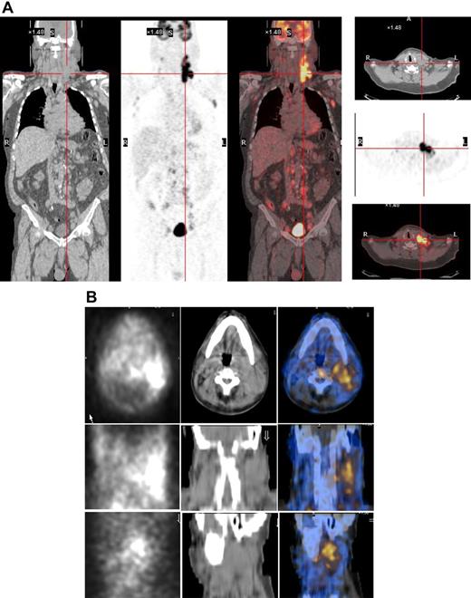 Figure 5. 131I-L19SIP uptake in lymphoma lesions in a patient (NHL1) with SLL NHL. (A) 18F-FDG PET scans demonstrate intense glucose metabolism in multiple enlarged lymph nodes, particularly in the left latero-cervical region. Coronal images are shown in the left panels and transaxial images of the cervical regions are displayed in the right panels. (B) The same patient received an intravenous infusion of 185 MBq and, subsequently, 5.55 GBq 131I-L19SIP. Transaxial, coronal, and sagittal SPECT-CT images of the cervical regions (first, second, and third rows, respectively) were acquired 8 days after the dose of 5.55 GBq. Left column shows scintigraphic images; central column, CT images; and right column, CT-scintigraphy fused images.