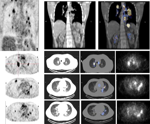Figure 6. 18F-FDG PET scans and 131I-L19SIP SPECT-CT images from an advanced Hodgkin lymphoma patient (HL1). 18F-FDG PET scans show intense glucose metabolism in multiple enlarged mediastinal lymph nodes, intrapulmonary lesions (leftmost column, first 4 images; intrapulmonary lesion marked), as well as in lumboaortic lymph nodes (leftmost image in lowest row). The same patient received intravenous injections of 185 MBq and, subsequently, 5.55 GBq 131I-L19-SIP. SPECT-CT coronal (top right panel) and transaxial images of the thorax (rows 2-4) as well as the upper abdomen (lowest row) are shown, demonstrating selective uptake of 131I-L19SIP into the 18F-FDG–labeled lymphomatous lesions.