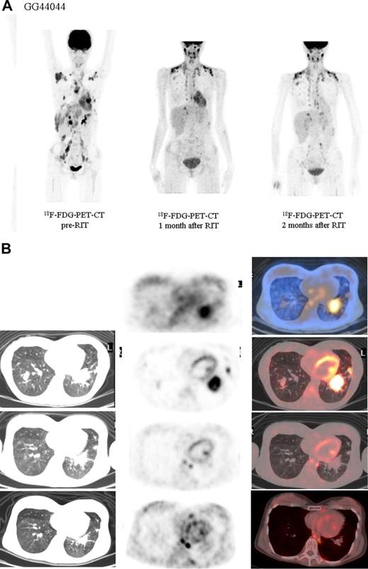 Figure 7. Objective partial remission in another advanced Hodgkin lymphoma patient (HL2) induced by 131I-L19SIP radioimmunotherapy. (A) 18F-FDG PET scans show intense glucose metabolism in multiple enlarged lymph nodes, particularly in right and left axillary and supraclavicular nodes, in paratracheal, subcarinal, peritoneal, and iliacal nodes as well as in lymphoma lesions located in the basal lobes of both lungs (leftmost image). One (center) and 2 (rightmost image) months after application of therapeutic 131I-L19SIP (3.7 GBq), the number and size of active lymphoma lesions decreased substantially. (B) 18F-FDG PET scans and 131I-L19SIP SPECT-CT images from the same patient. Transaxial SPECT-CT images (top row) show selective 131I-L19SIP uptake to a pulmonary lymphoma lesion still detectable 12 days after injecting a therapeutic dose (3.7 GBq). Transaxial 18F-FDG PET scans captured prior to (second row), 1 month after (third row) and 2 months after (bottommost row) application of therapeutic 131I-L19SIP show a significant shrinkage in size and a complete disappearance of metabolic activity in the initially large pulmonary lymphoma lesion, indicative of lymphoma response to 131I-L19SIP radioimmunotherapy.