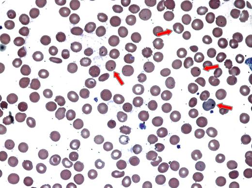 A 43-year-old man with history of relapsed diffuse large B-cell lymphoma was admitted for fever and cough. He had a history of prior autologous peripheral blood stem cell transplantation (PBSCT) 10 years earlier with subsequent disease progression. An allogeneic PBSCT from a HLA-matched unrelated donor was performed. His disease was in remission when he developed extensive chronic graft-versus-host disease (cGVHD) of skin and mouth. CT chest scan showed patchy consolidations. His peripheral blood showed Howell-Jolly bodies (red arrows). Subsequently, the patient died of pneumonia and progressive renal failure. / Chronic GVHD, which is associated with severe immune dysfunction and increased frequency of infections, may show numerous Howell-Jolly bodies. Normally, Howell-Jolly bodies are remnants of the erythroblast nucleus that are removed by the spleen. In patients with cGVHD, their appearance is associated with functional asplenia (Kalhs et al. Ann Intern Med. 1988;109:461-464).