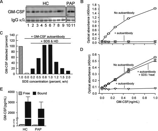 Figure 2. Concentration of free and IgG-bound GM-CSF in human serum. (A) Total IgG was isolated individually from the sera of healthy subjects (HC) or patients with PAP (PAP) using protein G and evaluated by Western blotting to detect GM-CSF (top panels) or IgGκ (κ) and -λ (λ) light chains (as a loading control, bottom blots). Each lane represents one subject. (B) Detection of free GM-CSF and autoantibody-bound GM-CSF in serum. A set of “standard” samples composed of recombinant human GM-CSF (Leukine) at various concentrations ranging from 0 to 30 ng/mL were prepared in mouse serum in the absence (○) or presence (▽) of purified human GM-CSF autoantibodies (30 μg/mL). Standard samples were diluted 1/30 with 1% BSA in PBS and then GM-CSF was measured using a commercial human ELISA kit (R&D Systems) as directed by the manufacturer. (C) Use of a novel ELISA (SDS-HD ELISA, see “Methods”) to quantify GM-CSF in PBS in the absence or presence of GM-CSF autoantibody (1 μg/mL) and in the absence or presence of a pretreatment with SDS and heat denaturation. Each bar represents the mean of duplicate determinations for 1 of 4 separate experiments with similar results. (D) GM-CSF level evaluated using a novel human GM-CSF ELISA as described in “Methods.” Symbols represent the same samples and conditions as described in the legend to panel B above. GM-CSF was detectable in the absence of GM-CSF autoantibody (○), undetectable in the presence of GM-CSF autoantibody in the absence of SDS-HD pretreatment (▽), and detection was restored in the presence of GM-CSF autoantibody by SDS-HD pretreatment (△). (E) Free GM-CSF (▨) or total GM-CSF (free and autoantibody-bound; ■) were measured in sera of healthy subjects (HC) or patients with PAP (PAP) using a commercially available ELISA or the SDS-HD ELISA, respectively, as described in “Methods.” Total serum GM-CSF levels in HC and PAP were not different (3048 ± 484, n = 11; PAP 2360 ± 668, n = 5; respectively, P = .43).