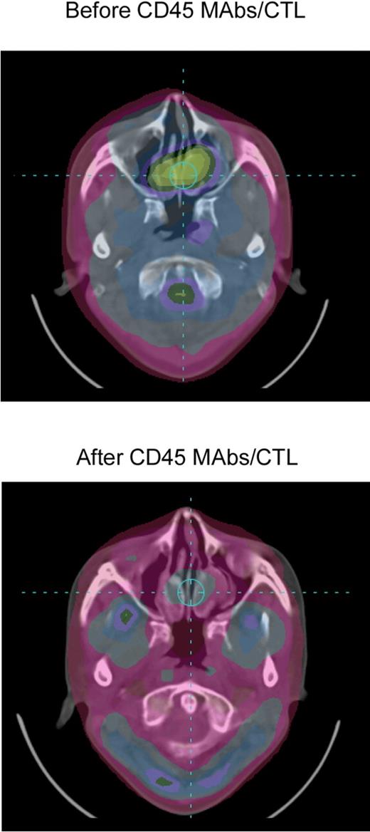 Figure 5. Complete response after lymphodepletion and EBV-specific CTL infusion. PET images of patient (P1740) before and 8 weeks after CD45 mAbs/EBV-CTL infusion.