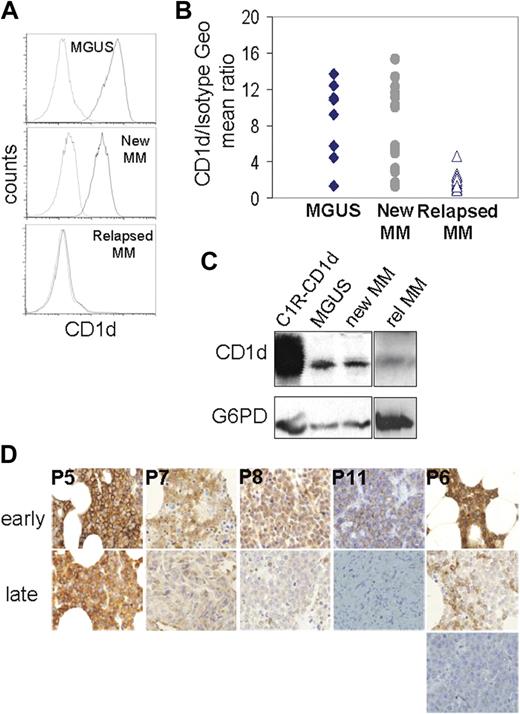 Figure 2. CD1d expression in primary myeloma cells ex vivo and in situ. (A) Surface expression of CD1d in bone marrow myeloma cells from patients in different stages of the disease was assessed by multicolor flow cytometry. Histograms are gated on plasma cells identified as CD138+CD38+CD45low/− (dotted line represents isotype; continuous line, CD1d). (B) CD1d expression as assessed by the Geo MFI CD1d/isotypic IgG1 ratio (to account for the day-to-day variability of the isotype control) in MGUS (n = 8), newly diagnosed (n = 18), and relapsed patients (n = 17). Geo MFI CD1d/ IgG1 ratio was similar between MGUS and newly diagnosed patients (P > .05), but considerably lower in patients with relapsed/advanced disease compared with MGUS (P < .01) and newly diagnosed patients (P < .01). (C) Western blot analysis of CD1d in plasma cells selected with CD138 immunomagnetic beads from a MGUS, a newly diagnosed and a patient with relapsed MM. The CD1d-transduced B-cell line C1R-CD1d was used as a positive control. (D) Assessment of CD1d expression in myeloma cells by immunohistochemistry. For patients P5, P6, P8, and P11, paired bone marrow trephine biopsies from early (ie, at diagnosis or after first chemotherapy) and late (relapse after allogeneic hematopoietic stem cell transplantation) disease were stained with anti-CD1d; in P6, 3 consecutive trephine biopsies were studied; in P7, the late sample was skin plasmacytoma.