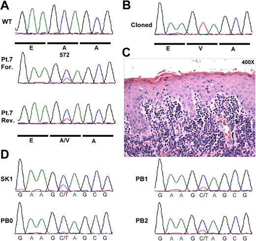 Figure 7. JAK3A572V mutation is present in human CTCL. (A) DNA samples from 30 patients with CTCL were PCR amplified and resequenced using M13-tailed primers flanking exon 12 of the human JAK3 gene. Forward (For.) and reverse (Rev.) sequence traces from Patient 7 (Pt.7) sample as well as wild-type trace are shown. (B) PCR products obtained in (A) were cloned and individually sequenced. Eleven of 44 (25%) products showed the mutant JAK3A572V allele. (C) Hematoxylin&Eosin staining of the skin biopsy shown in (A). (D) Sequence traces from Patient 7 (Pt.7) biopsies collected during disease progression. SK1 indicates skin biopsy at diagnosis prior to large-cell transformation shown in panel A; PB0, peripheral blood at diagnosis; PB1, before diagnosis of large cell transformation; and PB2, after diagnosis of large cell transformation.