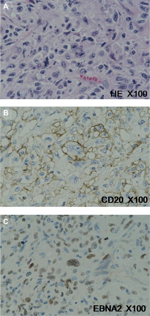 Figure 1. Histopathologic profile of age-related EBVLPD. (A) Hodgkin and Reed-Sternberg (HRS)–like giant cells were frequently observed scattered among reactive cells. These cells showed CD20 expression (B), in addition to positive signals for EBNA2 (C). Images were acquired using an Olympus AX80 microscope (Olympus, Tokyo, Japan) with a 100×/1.35 oil Iris lens (Olympus). Staining was with L26/CD20 and EBNA2 (Dako, Glostrup, Denmark). Images were captured with an Olympus DP70 camera and processed with Adobe Photoshop Elements, version 7 (Adobe Systems, San Jose, CA).