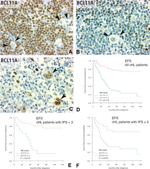 Figure 3. Immunohistochemical patterns of Bcl11A expression in classical Hodgkin lymphoma and correlations with survival. (A,B) The usual pattern of BCL11A positivity in cHL tissues. The immunostaining is located mainly in the nucleus of reactive small lymphocytes surrounding Reed-Sternberg cells (arrows). Variable numbers of positive plasmacytoid dendritic cells were also observed. The number of positive reactive cells scored as high/score 3 or low/score 1 (A and B, respectively) was strongly correlated with EFS in the whole population of 143 informative patients (different from those analyzed by DNA microarrays), as shown by Kaplan-Meier estimates (D). Among these patients, Bcl11A positivity has also a significant prognostic value in the subgroup of patients with an international prognostic score of 2 or less (E) and in patients with an IPS more than 2 (F) as shown by Kaplan-Meier estimates of EFS. Panel C illustrates an infrequent pattern of Bcl11A expression in cHL tissues, with a positive signal located in neoplastic Reed-Sternberg cells (). This latter pattern was not statistically correlated with survival. Panels A-C correspond to a 40×/0.75 objective lens (×400 magnification).
